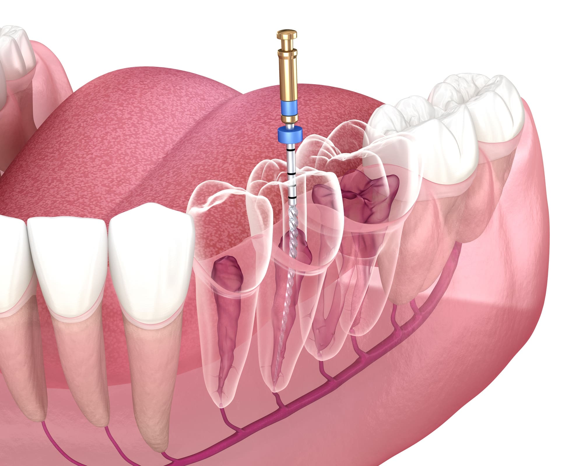 Root Canal Therapy