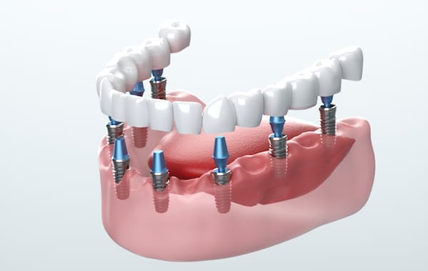 New Haven Dental Implants